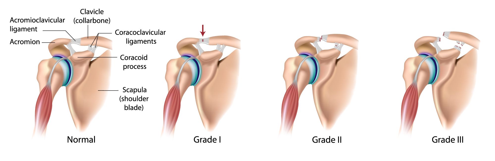 AC Joint Injury Grades (Rockwood Classification)